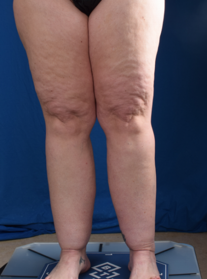 Legs Liposuction Before & After Patient #1992