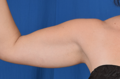 Arms Liposuction Before & After Patient #1969
