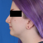 Chin Liposuction Before & After Patient #2077
