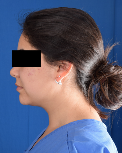 Chin Liposuction Before & After Patient #2084