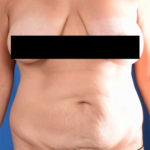 Tummy Tuck Before & After Patient #2093