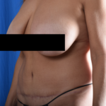 Tummy Tuck Before & After Patient #2093