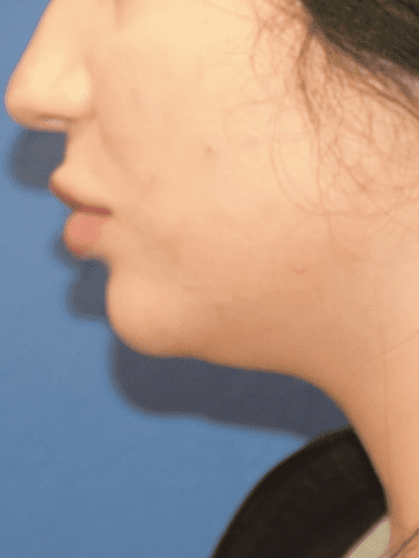 Chin Liposuction Before & After Patient #2250