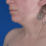 Chin Liposuction Before & After Patient #2245