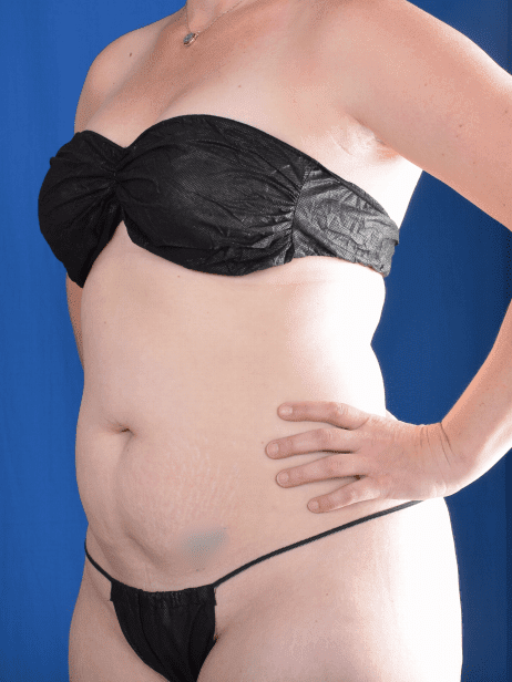 Torso Liposuction Before & After Patient #2268