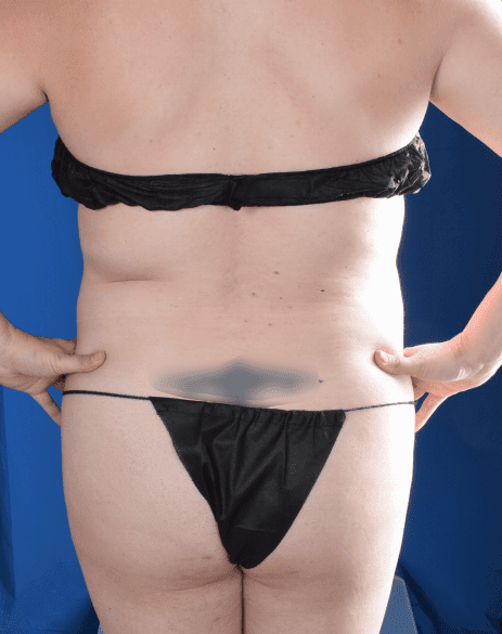 Torso Liposuction Before & After Patient #2284