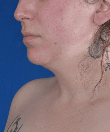 Chin Liposuction Before & After Patient #2245