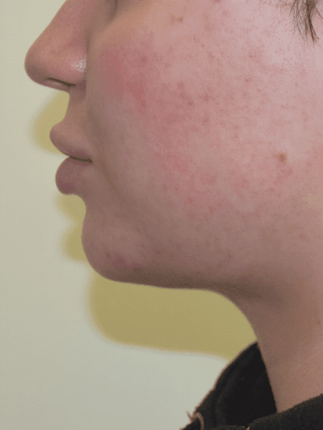 Chin Liposuction Before & After Patient #2250
