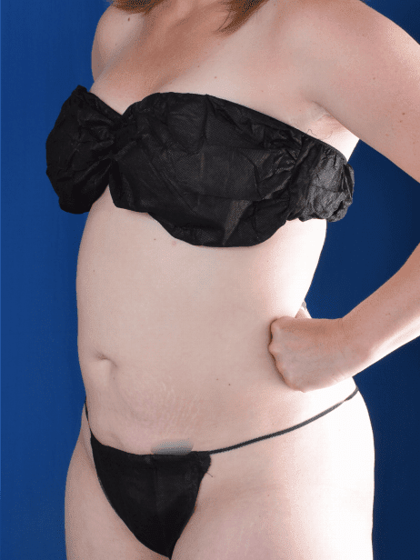 Torso Liposuction Before & After Patient #2268