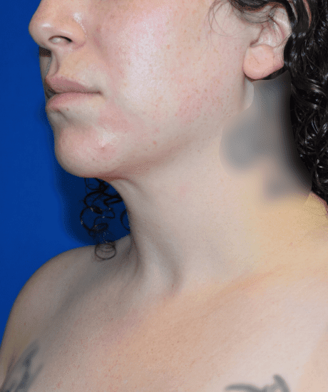 Chin Liposuction Before & After Patient #2245