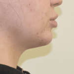 Chin Liposuction Before & After Patient #2250