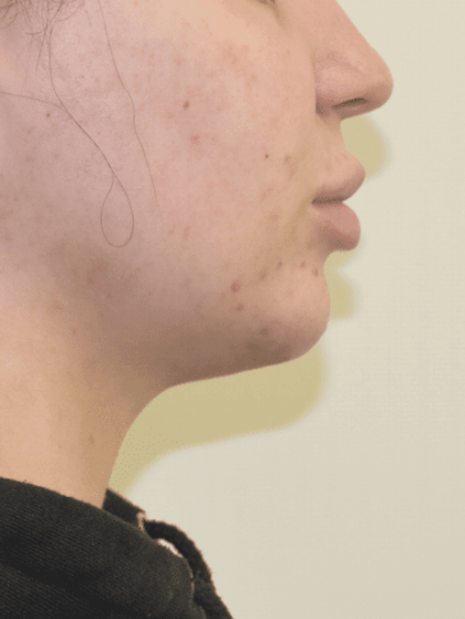 Chin Liposuction Before & After Patient #2250