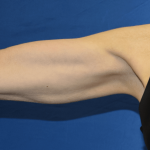 Arms Liposuction Before & After Patient #2240