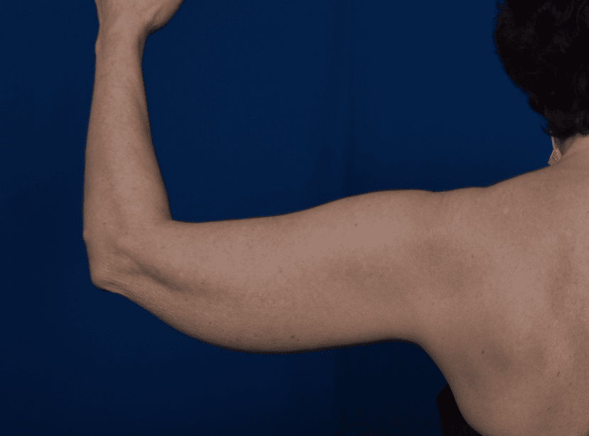 Arms Liposuction Before & After Patient #2240