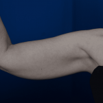 Arms Liposuction Before & After Patient #2240