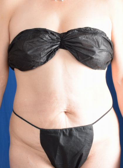 Tummy Tuck Before & After Patient #2350