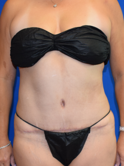 Tummy Tuck Before & After Patient #2350