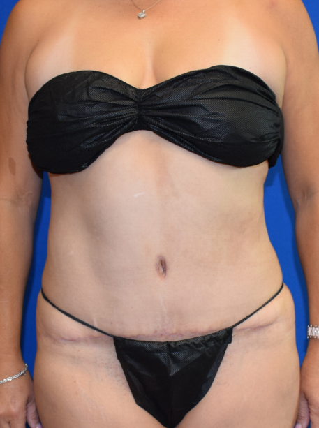 Tummy Tuck Before & After Patient #2350