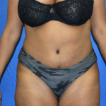 Tummy Tuck Before & After Patient #2363