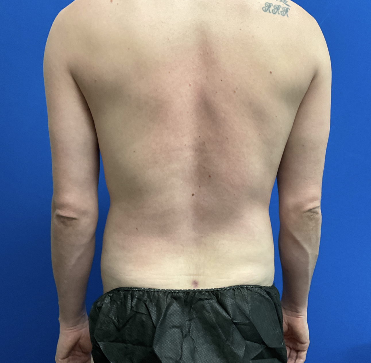 Torso Liposuction Before & After Patient #2339