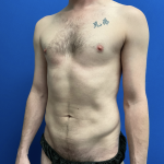 Torso Liposuction Before & After Patient #2339