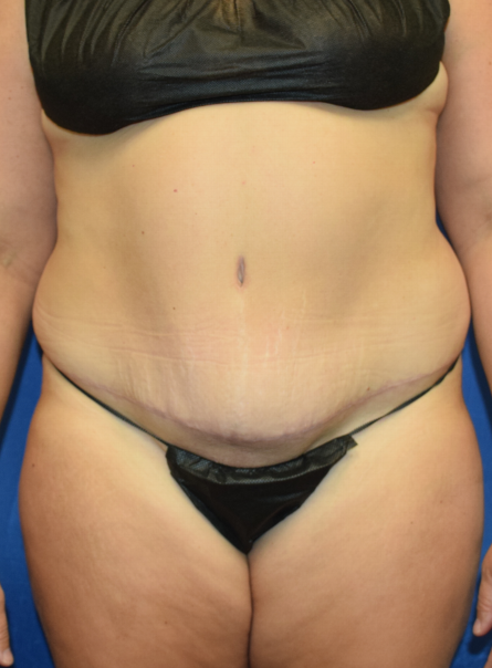 Tummy Tuck Before & After Patient #2356