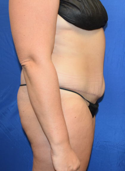 Tummy Tuck Before & After Patient #2356