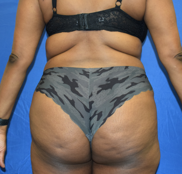Brazilian Butt Lifts (Women BBL) Before & After Patient #2334