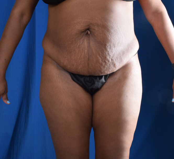 Tummy Tuck Before & After Patient #2363