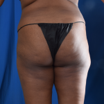 Brazilian Butt Lifts (BBL) Before & After Patient #2334