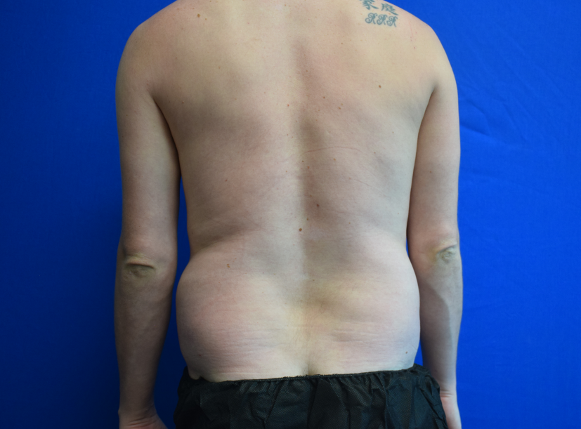Torso Liposuction Before & After Patient #2339