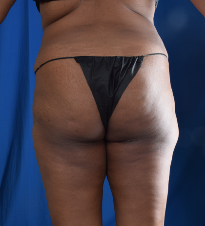 Brazilian Butt Lifts (BBL) Before & After Patient #2334