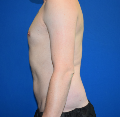 Torso Liposuction Before & After Patient #2339