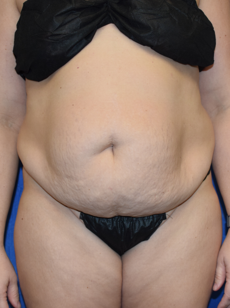 Tummy Tuck Before & After Patient #2356