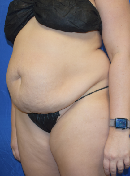 Tummy Tuck Before & After Patient #2356