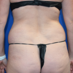 Brazilian Butt Lifts (BBL) Before & After Patient #2410
