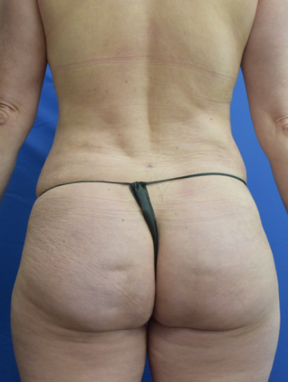 Brazilian Butt Lifts (BBL) Before & After Patient #2410