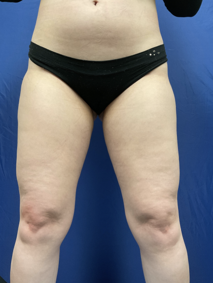 Legs Liposuction Before & After Patient #2412