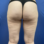 Legs Liposuction Before & After Patient #2412