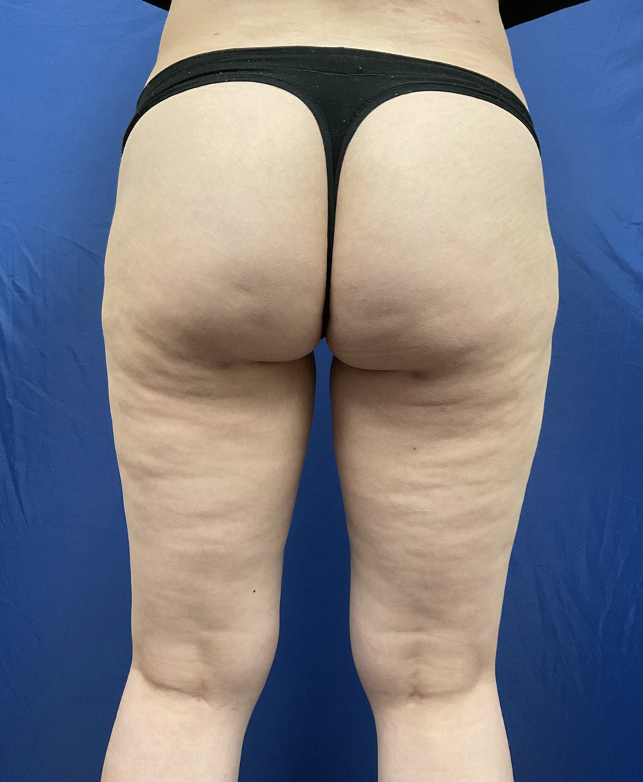 Legs Liposuction Before & After Patient #2412