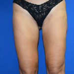Legs Liposuction Before & After Patient #2413