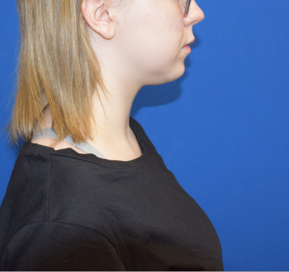 Chin Liposuction Before & After Patient #2411