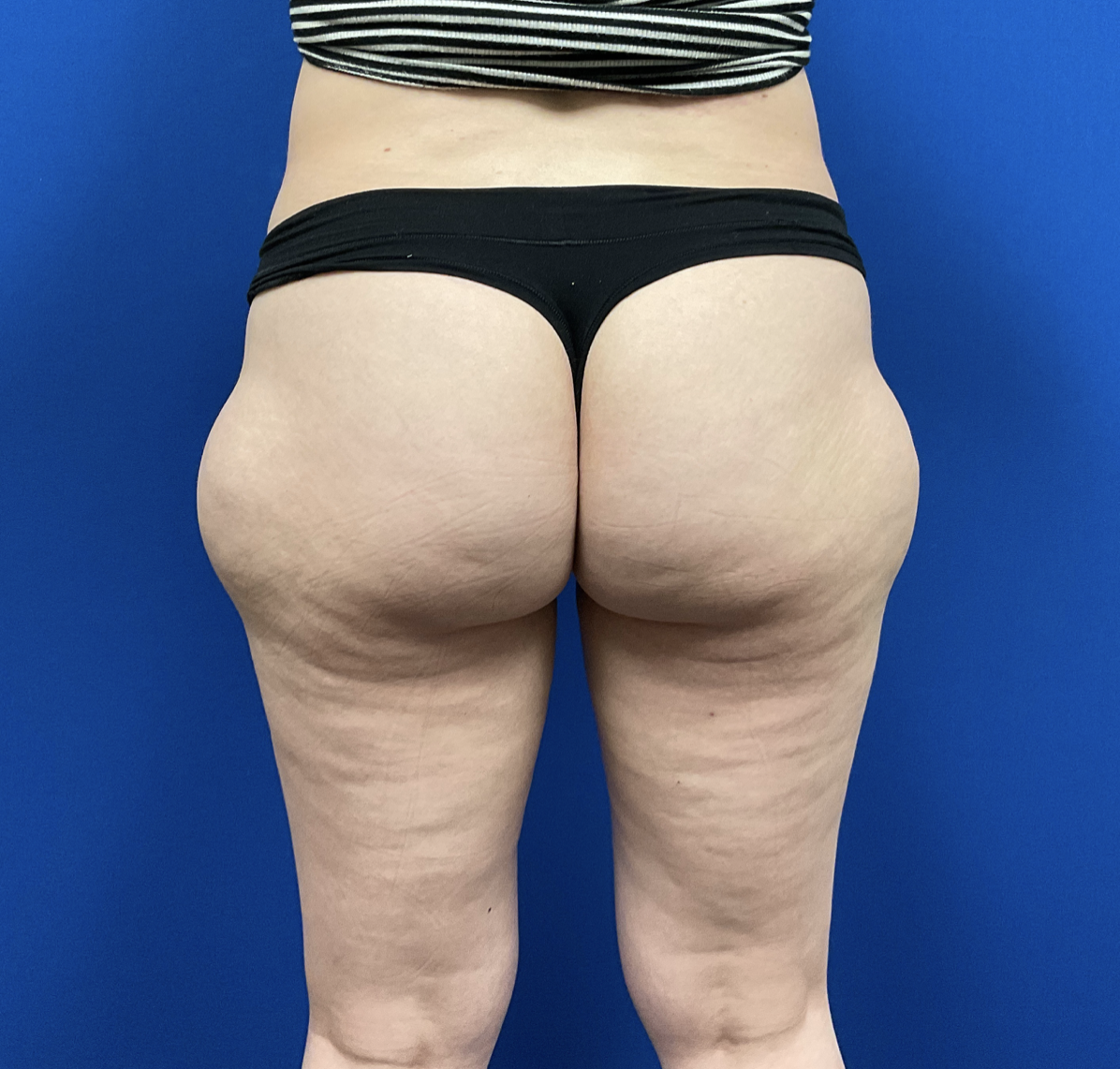 Legs Liposuction Before & After Patient #2412