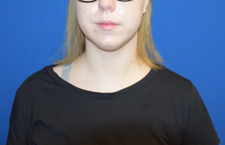 Chin Liposuction Before & After Patient #2411
