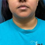 Chin Liposuction Before & After Patient #2482