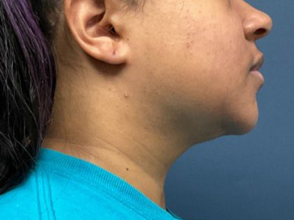 Chin Liposuction Before & After Patient #2482