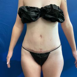 Tummy Tuck Before & After Patient #2758