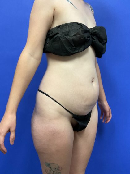 Tummy Tuck Before & After Patient #2758