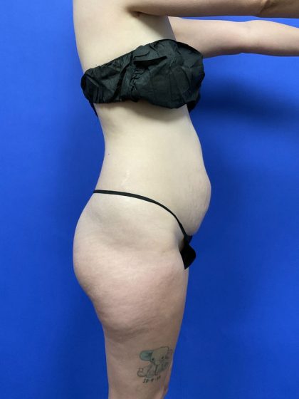 Tummy Tuck Before & After Patient #2758