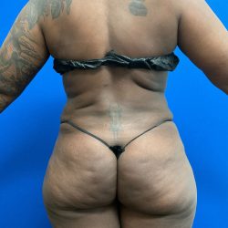Torso Liposuction Before & After Patient #2753